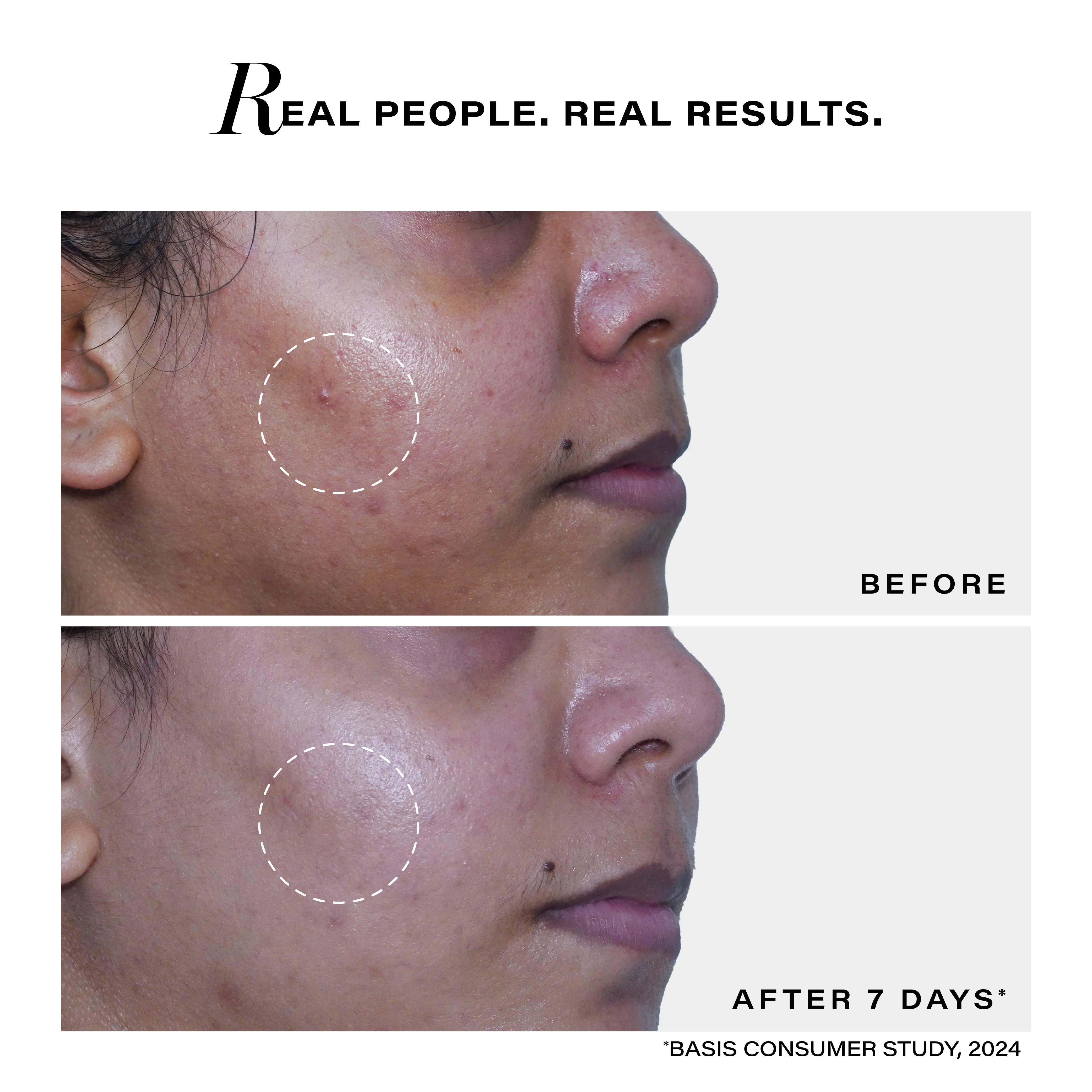 Acne Deep Clearing Cleanser - Image 5