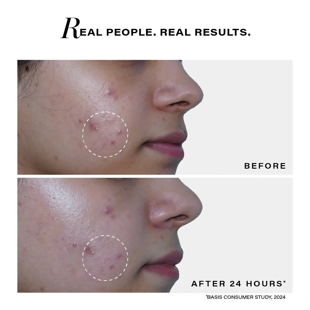 Acne Rescue Spot Corrector, 30g - Image 6